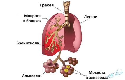 Stadiul pneumoniei cronice, simptome, prevenire și tratament