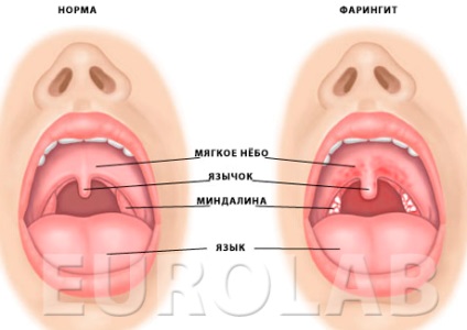 A pharyngitis kezelése - orvosi portál eurolab