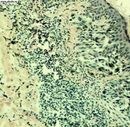 Melanomul medical Enciclopedia