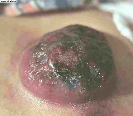 Melanomul medical Enciclopedia