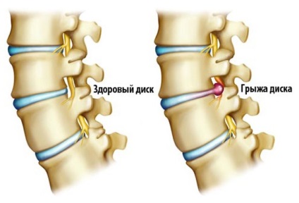 Hernia intervertebrală - tratamentul și prevenirea în sanatoriile de ural și prețurile rusiei 2018