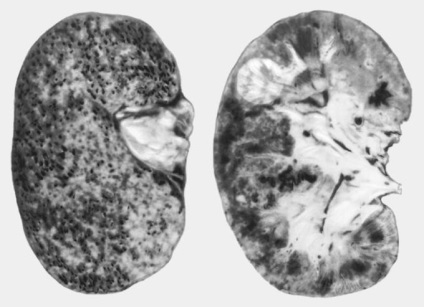 Nephrosclerosis okoz, tünetek, diagnózis és kezelés