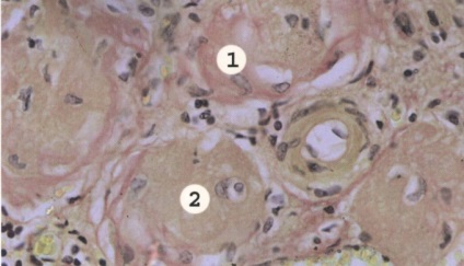 Nephrosclerosis okoz, tünetek, diagnózis és kezelés