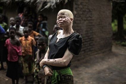 Nem úgy, mint az összes afrikai albínót, hogy megölnek amuletteket