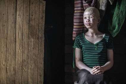 Nem úgy, mint az összes afrikai albínót, hogy megölnek amuletteket
