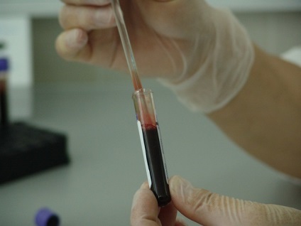 Tratamentul și prevenirea sângerării nazale