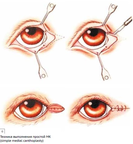 Experiență în aplicarea cantoplastiei medii modernizate în sindromul ocular brachycephalic