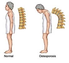 Osteoporoza provoacă osoase, tratament și prevenire - un manual de sănătate