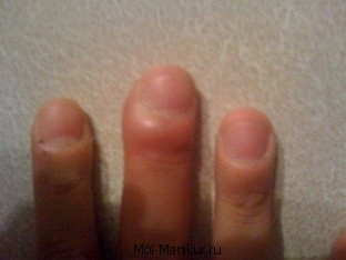 Уитлоу пръст за Методи за третиране на ръка, примери снимка