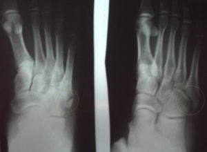 Fractura de 5 os metatarsal cu sau fara deplasare