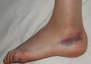 Fractura de 5 os metatarsal cu sau fara deplasare