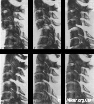 Fracturile și dislocările vertebrelor cervicale