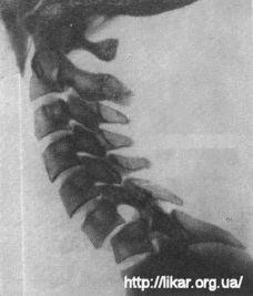 Fracturile și dislocările vertebrelor cervicale