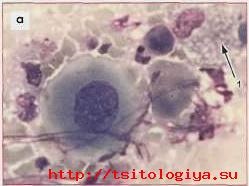 Carcinomul celulelor scuamoase