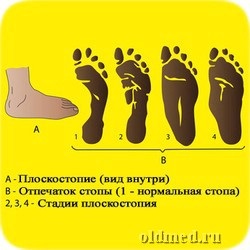 Picioarele picioare - tratament cu remedii folclorice
