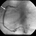 Indicații pentru recomandările de angiografie coronariană - tratament cardiac