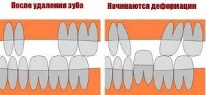 Последиците и усложненията на кариес (зъб болки, реакцията на студена и топла и т.н.)
