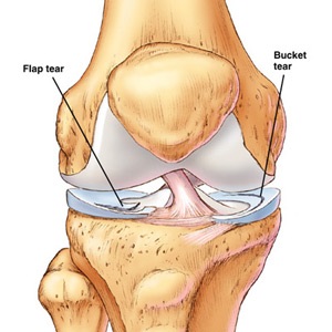 Deteriorarea meniscului articulației genunchiului