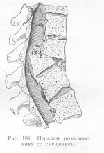 Leziunile coloanei vertebrale, ghidul medicului
