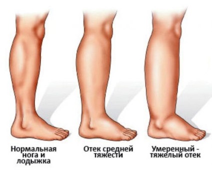 Cauze, prevenirea și tratamentul edemului piciorului