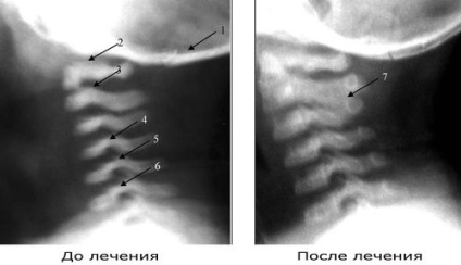 Utilizarea terapiei manuale în tratamentul traumatismelor la naștere la nivelul coloanei vertebrale cervicale la copiii sub vârsta de un an