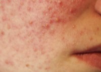 Pimples de fumat - poate fi, pe fata, dupa refuz, nu afecteaza, apar, adevarat sau nu