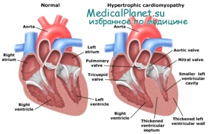 Semne de cardiomiopatie hipertrofică