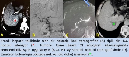 Cancer la ficat, radiologie intervențională în tratamentul cancerului