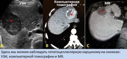 Cancer la ficat, radiologie intervențională în tratamentul cancerului