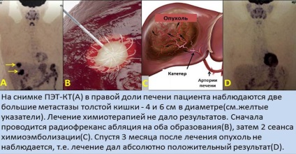 Cancer la ficat, radiologie intervențională în tratamentul cancerului