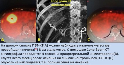 рак на черния дроб, интервенционална радиология лечение на рак