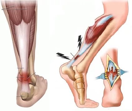 Ruperea tratamentului și recuperarea tendonului Achilles după intervenție chirurgicală