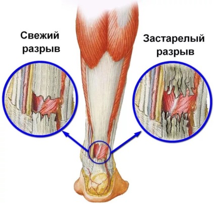 Ruperea tratamentului și recuperarea tendonului Achilles după intervenție chirurgicală