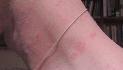 Pink lichen zhibera fotó, okok, kezelés, bőrbetegségek
