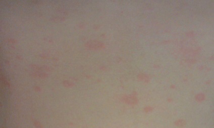 Pink lichen zhibera fotó, okok, kezelés, bőrbetegségek