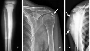 Sindromul articular, cancerul - tratament și prevenire