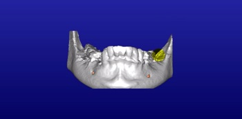 Șabloane pentru implantarea dinților