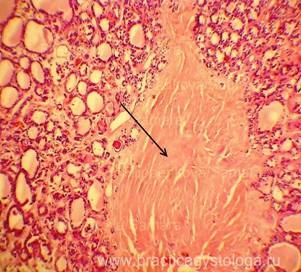 Glanda tiroidă - practica histologului