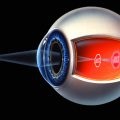 Metode pentru tratarea miopiei legate de vârstă, a bolilor oculare