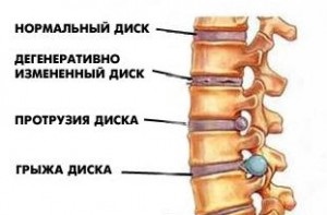 Az intervertebrális hernia törlése műtét után