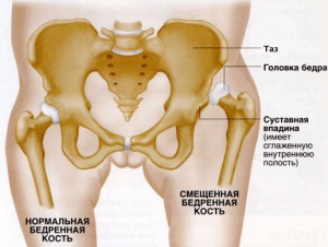 Dislocarea simptomelor de șold de col uterin, cauze, tratament, predicții