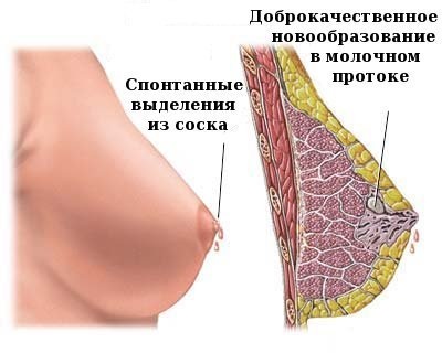 Intracurentul papilomului glandei mamare
