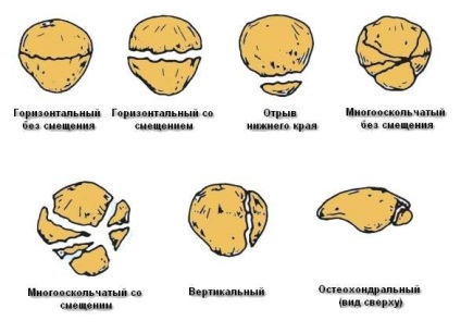 Fracturi intraarticulare ale articulației genunchiului