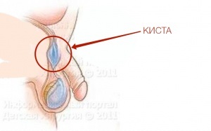 Scăderea tratamentului cordului spermatic (funiculocele) și consecințele asupra copiilor și bărbaților