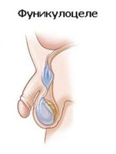 Dropsa cordonului spermatic - hidrocel, funicular