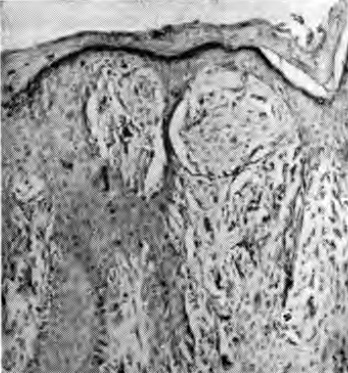 Juvenile melanom (nevus spitz) - tumori pigmentare benigne și preneoplasm -