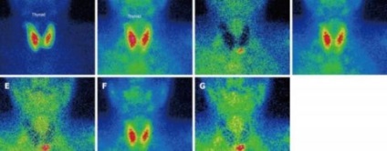 Parathyroid betegség - a tünetek a nők és a kialakulásának okai