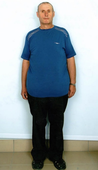 Timp de doi ani, un rezident al regiunii Ternopil, care pierdea in greutate conform sistemului doctorului Mirkin, a scazut 132 de kilograme