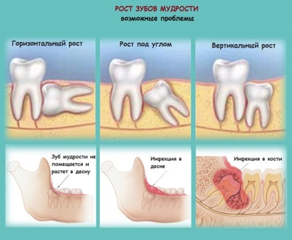 Intelepciunea dintilor pentru indepartarea sau vindecarea maestrului