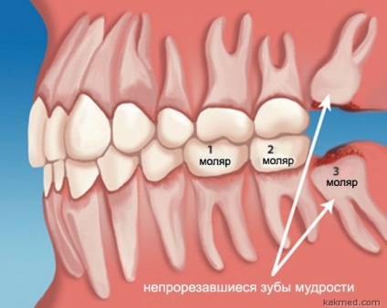 Intelepciunea dintilor pentru indepartarea sau vindecarea maestrului